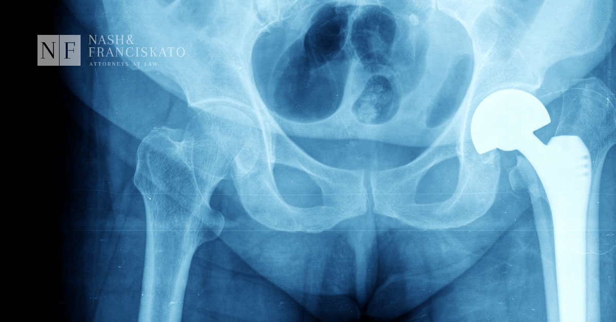 Biomet Metal-on-Metal Hip Replacement Destroys Patient’s Pelvis