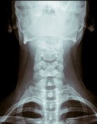 car accident injury to neck spinal cord