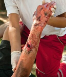 burn injuries contact burns physical scars emotional trauma