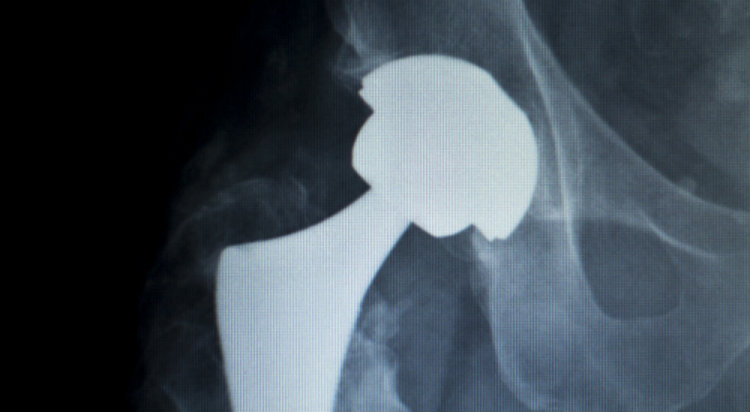 Hip Implant