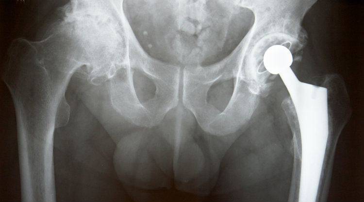 Biomet Magnum Hip Implant