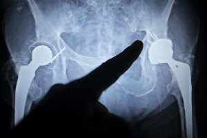 Metal on metal hip replacement xray complications