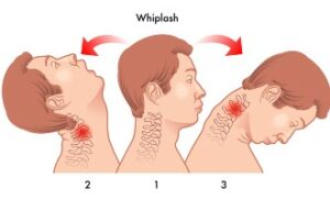 common delayed accident symptoms car accident serious injuries neck and shoulder pain whiplash